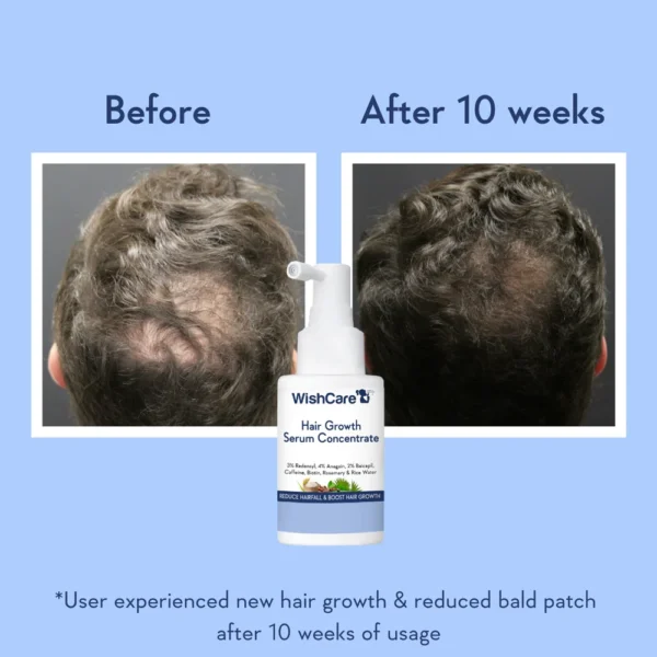 Hair Growth Serum Concentrate – Reduces Hair Fall, Boosts New Growth & Increases Hair Density | Lightweight & No Side Effects - Image 5
